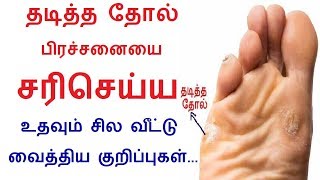 Home Remedy to treat the problem of Corns and calluses in Tamil | Rahul Beauty Health tips in Tamil