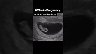 First Month Pregnancy Scan