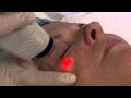 Ultapulse CO2 Laser Treatment Under the Eyes