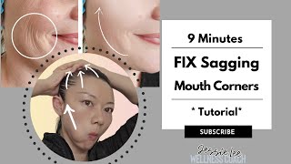 The Best Solutions for Sagging Mouth Corners