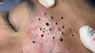 Loan Nguyen Acne Treatment 9y