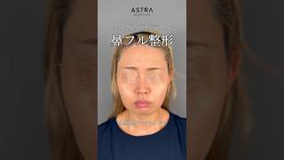 【小鼻の広がりを抑えシュッとした忘れ鼻へ】 #astrabeautyclinic #美容整形 #鼻整形 #忘れ鼻 #アストラビューティクリニック #小鼻縮小