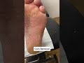 Callus and Corn Removal by Podiatrist | Latest Techniques with Ergonx and Docpods