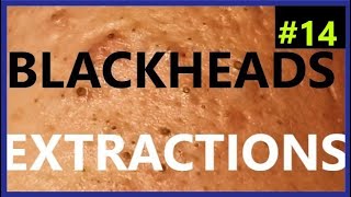 BLACKHEADS EXTRACTIONS on Happy #14