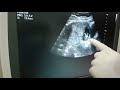 ivf surat test tube baby ચાલો આપણે વંધ્યત્વ સારવાર વિશે ડો.ગૌરવ ચાવડાપાસેથી જાણીયે