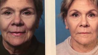 Watch a Facelift with PRP - Before and After Surgery - Dr. Anthony Youn