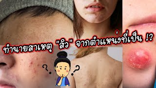 สิวบุก ทำไงดี?! ตำแหน่งที่สิวขึ้นบอกเหตุ สิวอุดตัน สิวอักเสบ รักษาเองยังไง? | พี่หมอพาสวย Ep.29