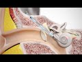 How a cochlear implant works