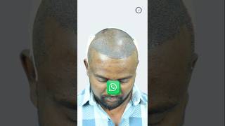 Amazing Hair Transplant Surgery in India | Using The Latest Technology \u0026 Techniques #hairtransplant