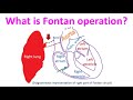 What is Fontan operation?