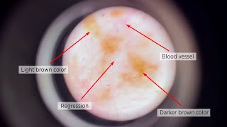 Important features of melanoma.