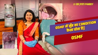 OSMF में मुँह का condition कैसा होता है||