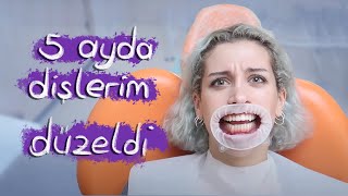 Şeffaf Plak Tedavim | Bilmeniz Gereken Her Şey