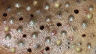 Big Pimples | Acne Treament Under The Skin #02 | Relax Every Day With Thuy Truong Sac Dep Spa | Acne
