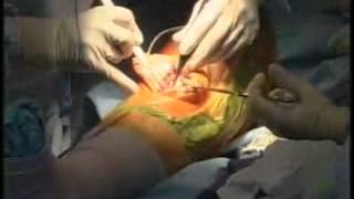 Live knee replacement surgery video