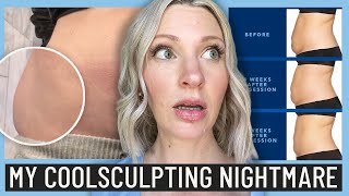 I Got BOTCHED CoolSculpting & *Almost* Got Plastic Surgery (I’m Finally Ready to Share This Story)
