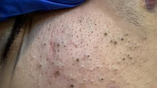 Soko Blackheads Removal (The Ultimate Facial Care Routine For Deep Pore Cleansing & Clear Skin)