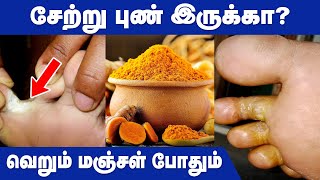 சேற்றுப்புண் பிரச்சனைக்கு மஞ்சள் மட்டும் போதும் | Tips To Cure Mud Sore | IBC Health