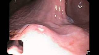 Type II Peptic Ulcer