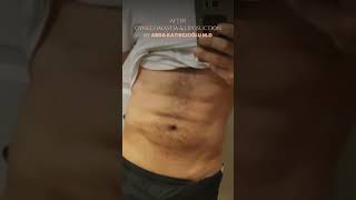 Hi def Liposuction \u0026 Jinekomasti | Op. Dr. Arda Katırcıoğlu