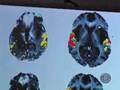 Pacemaker For The Brain? (CBS News)