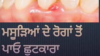 𝙝𝙤𝙬 𝙩𝙤 𝙥𝙧𝙚𝙫𝙚𝙣𝙩 𝙥𝙮𝙤𝙧𝙧𝙝𝙚𝙖। ਮਸੂੜਿਆਂ ਦੇ ਰੋਗਾਂ ਤੋਂ ਕਿਵੇਂ ਬਚੀਏ। #pyorrhea #prevention