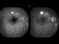 central serous retinopathy case