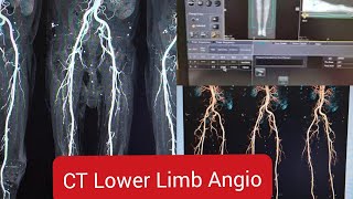 CT Scan Lower Limb Angiography on Toshiba 64 Slice.