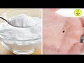 ತಿಗಣೆ ಕಾಟಕ್ಕೆ ಪರಿಹಾರ home remedies to get rid of bed bugs in kannada