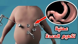 شاهد كيف يتم اجراء عملية تكميم المعدة_Sleeve gastrectomy and gastric bypass surgery