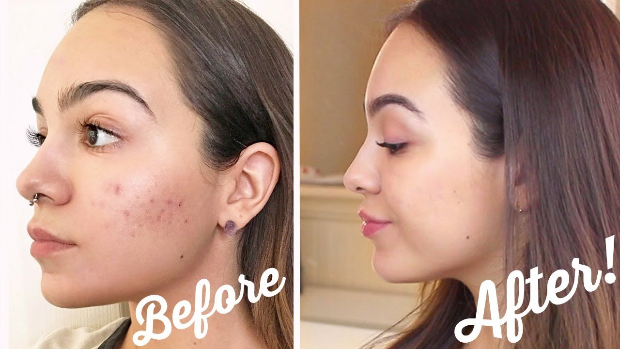 Skincare Routine - How I Cleared My Acne! - YouTube