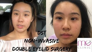 NO KNIFE 🔪DOUBLE EYE LID SURGERY// NON - INVASIVE// DST JOURNEY