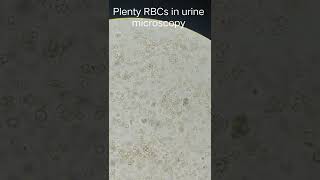 Plenty RBCs in Urine microscopy #shorts