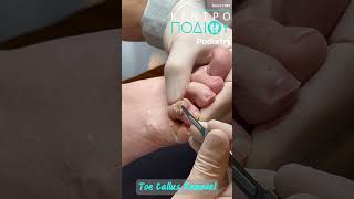 Toe Callus removal #foot #footcare #podologos #calluses #feet #footpain #athlete #podiatrist