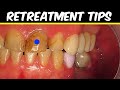 Root Canal Retreatment Tips (