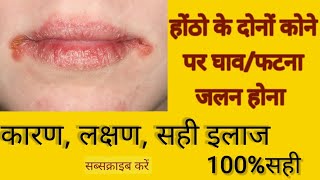 होंठो के किनारे सें फटना,छाले होंने का कारण, इलाज ||Angular Chielitis, Causes,Symptoms, Treatment