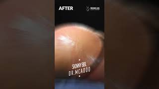 Skinny Brazilian Butt Lift (BBL) - Dr.McAdoo - MiamiLife Plastic Surgery