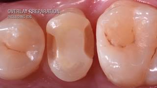 KATANA AVENCIA BLOCK overlay cementation