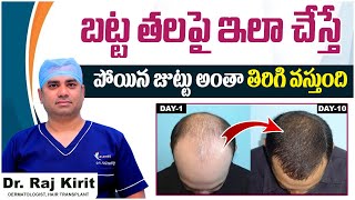 బట్ట తలపై ఊడిన జుట్టు తిరిగి రావాలంటే? | Get regrow hair on bald head and stop hair falling Celestee