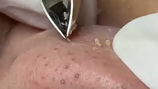 Satisfying white head extraction with Tweezers | blackheads, relax, skin care