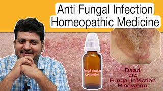 दाद खाज खुजली | Ringworm Fungal Infection Homeopathic Medicine Best Combination | How to use