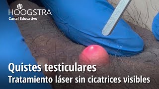 Quistes testiculares  - Tratamiento láser sin cicatrices visibles - 22286