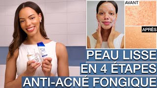 Mini-boutons, Peau Granuleuse \u0026 Texturée : 4 Produits pour en venir à bout ! | Acné Fongique