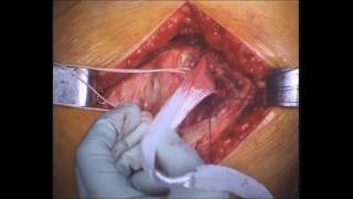 LARS Gluteal Repair live surgery video   Dr Greg Janes