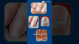 The White Spots On Fingernails Explained Shorts