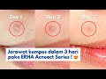 SKINCARE UNTUK MENGHILANGKAN JERAWAT DALAM 3 HARI PAKE ERHA ACNEACT SERIES