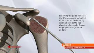 Extremity Procedural Kit (EPK) Surgical Technique Animation (upper)