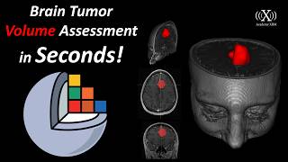 Brain Tumor Segmentation and Volume Assessment in 50 Seconds Using 3D Slicer
