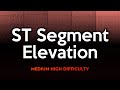 ST-Segment Elevation ECG Quiz: Medium to High Difficulty