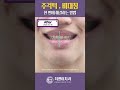 안면비대칭과 주걱턱을 한 번에 교정하는 방법 shorts